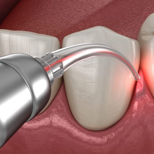 Gum correction surgery with laser.  Medically accurate tooth 3D Gum correction surgery with laser.  Medically accurate tooth 3D illustration